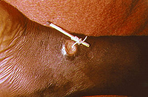 Dracunculus medinensis Der Wurm ist als weißes fadenähnliches Gebilde zu erkennen. Abgebildet ist die Entfernung mittels Streichholz.