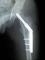 Cdm hip implant 348.jpg